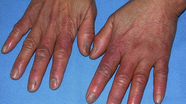Cách massage khi ngón tay bị sưng, nhức